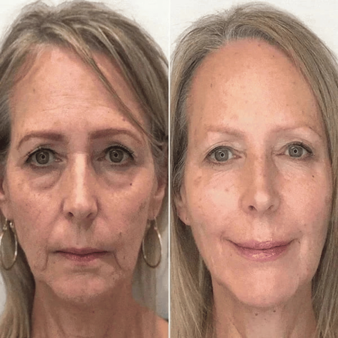 FACELIFT | Babybotox Face Serum