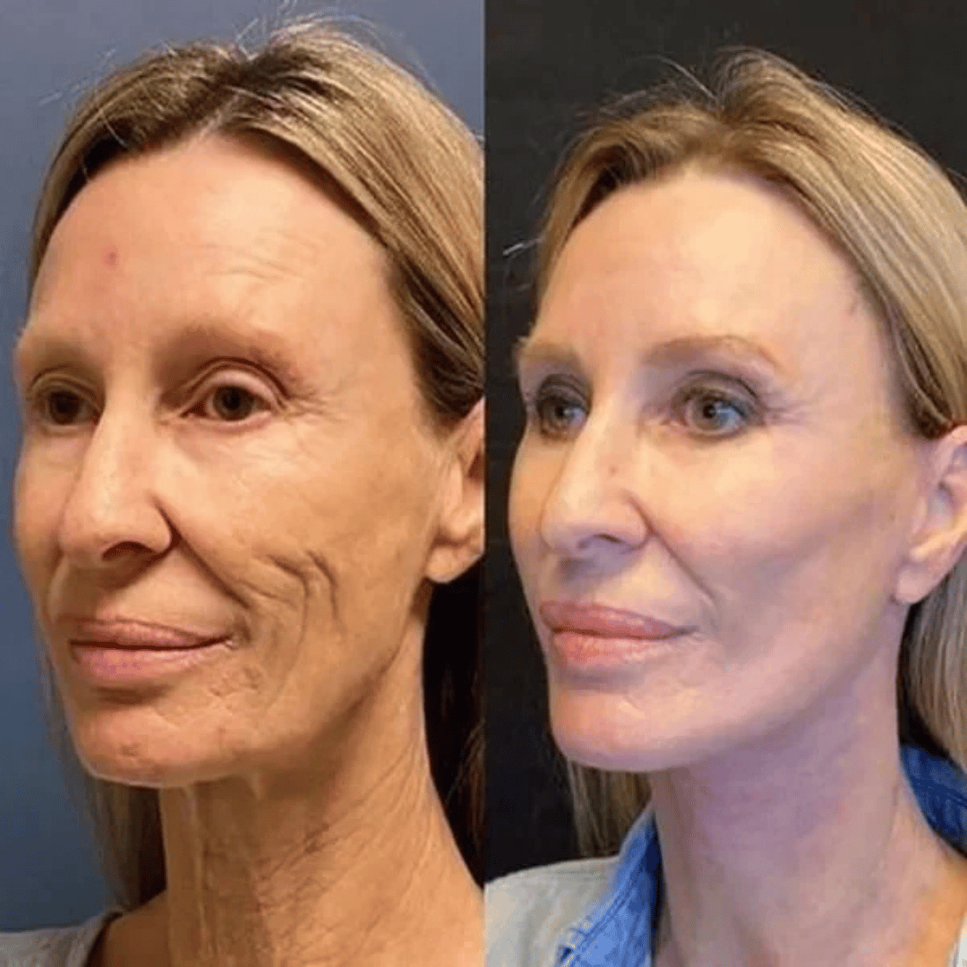 FACELIFT | Babybotox Face Serum
