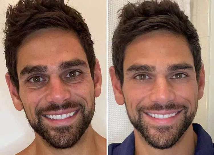 BotoxPRO